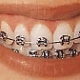 Color Braces