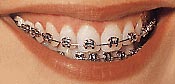 Color Braces