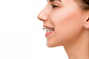 beautiful-young-woman-with-teeth-braces